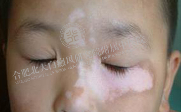 與白癜風(fēng)說拜拜，重新恢復(fù)燦爛笑容